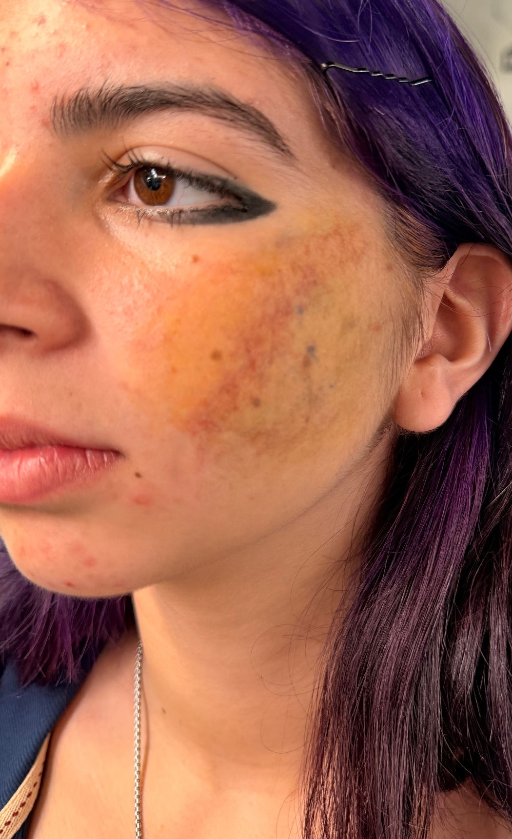 Painted facial bruise on live model