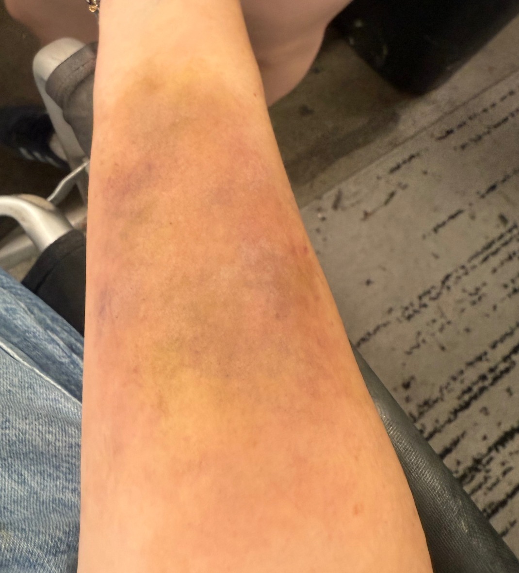 Healing forearm bruise, painted on live model