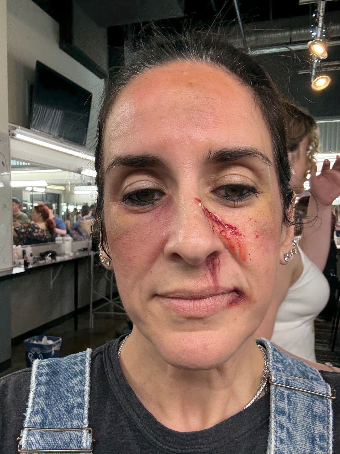 Nose laceration with orbital bruising on live model