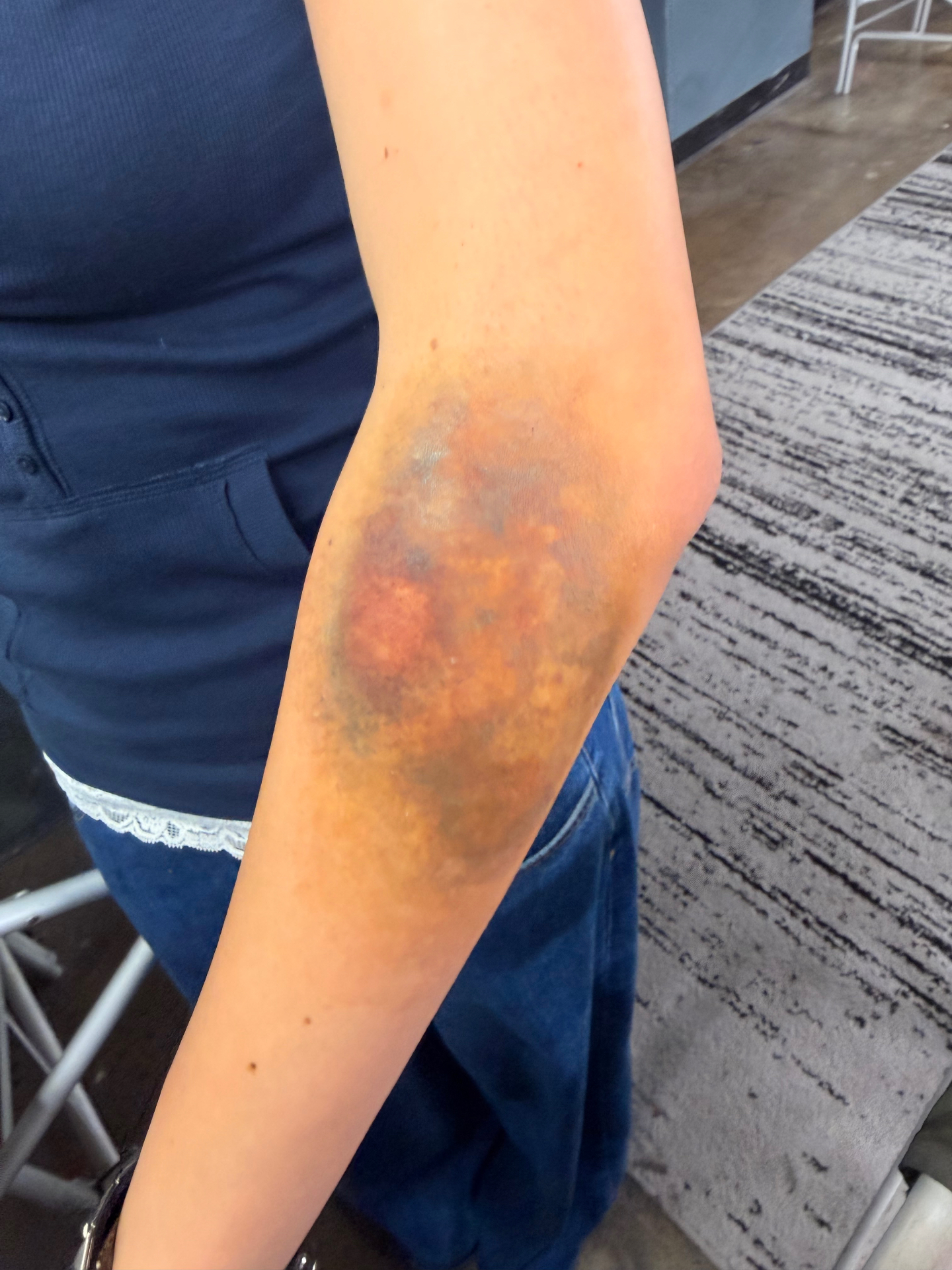Painted deep bruise on inner elbow