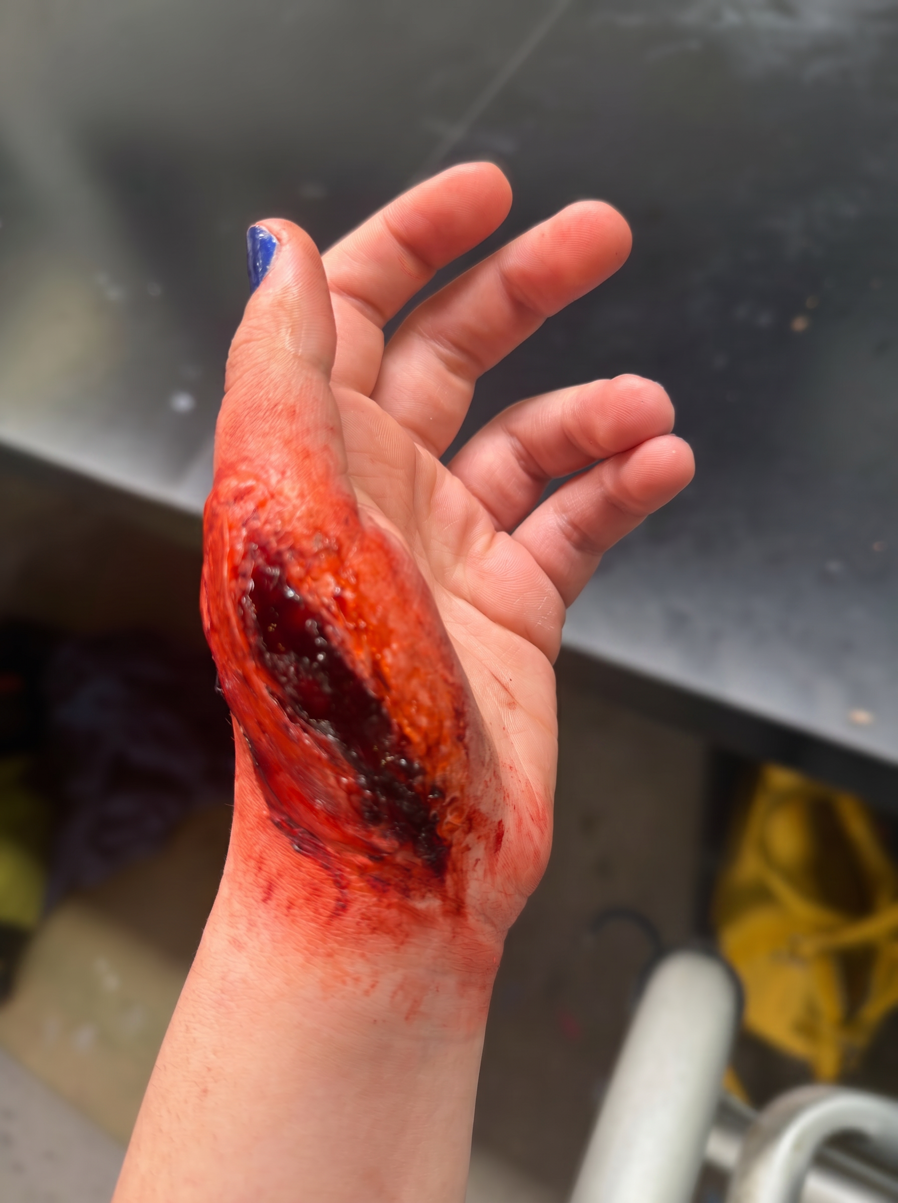 Deep avulsion wound simulation on hand