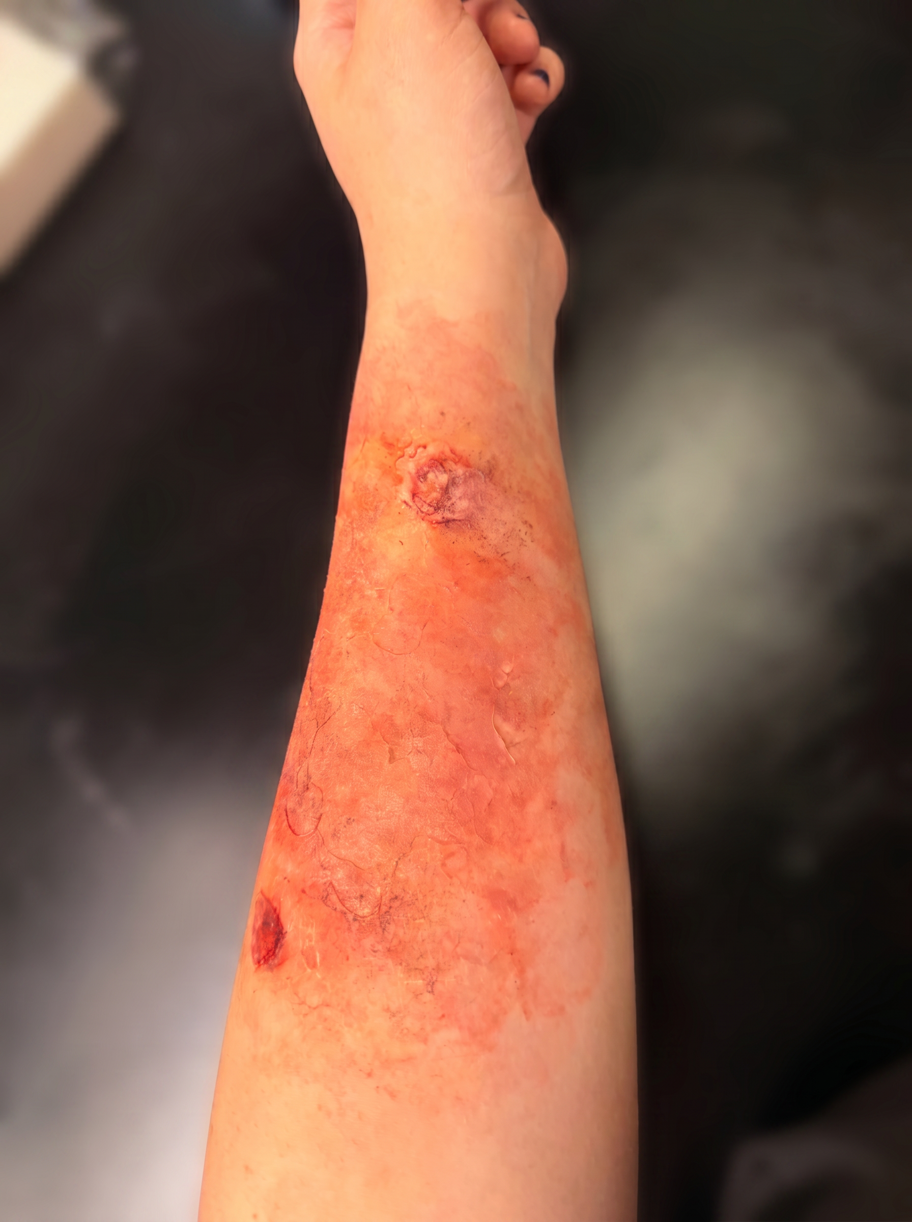 Burn and road rash trauma simulation