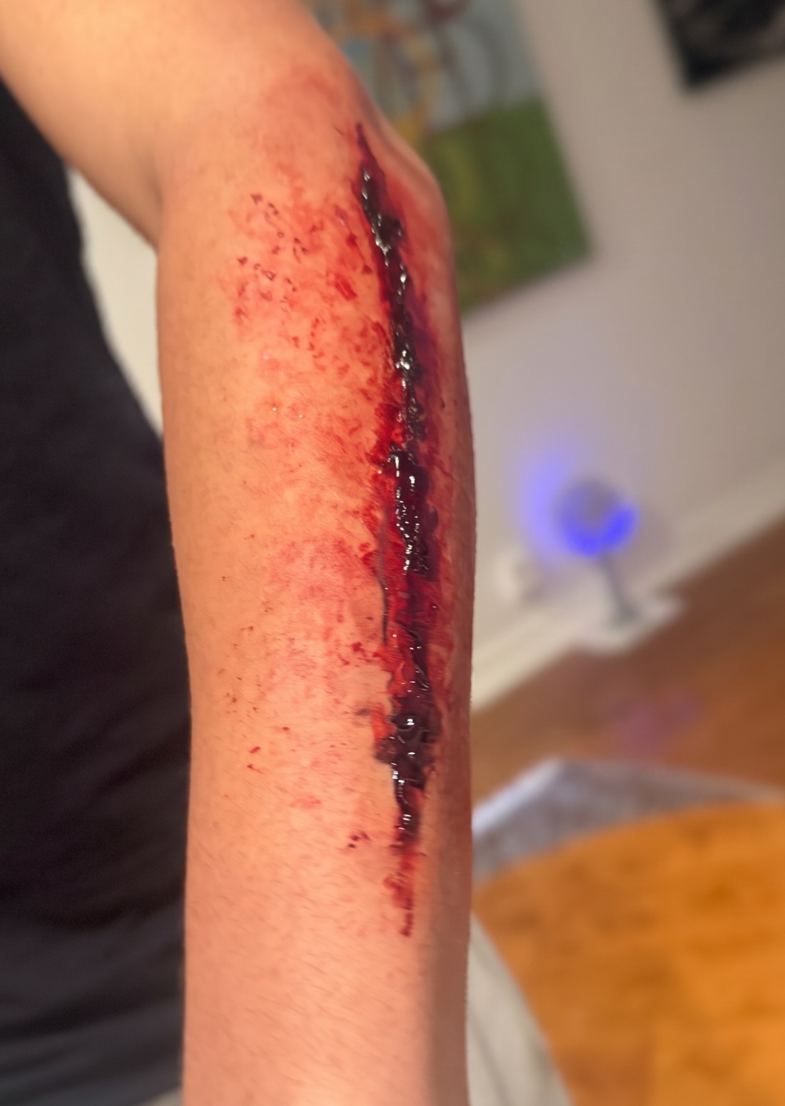 Long forearm laceration