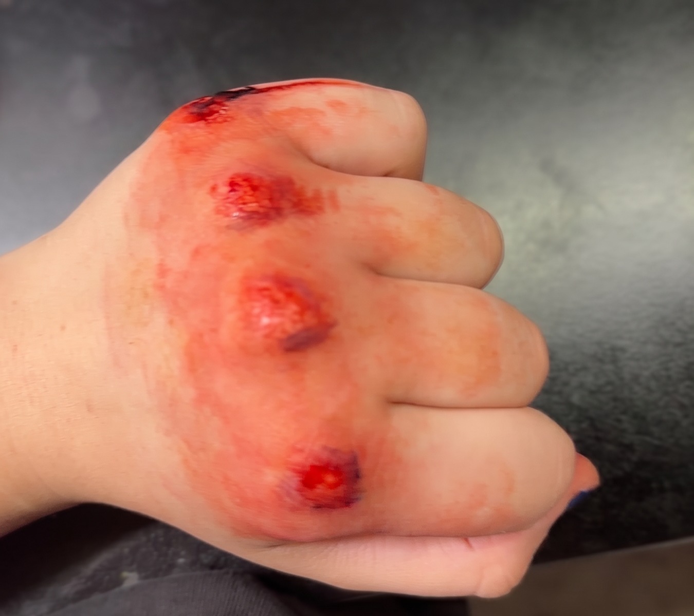 Knuckle contusion trauma